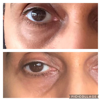 Dark Circles Under Eye Oil